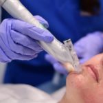 Microneedling Beverly Hills