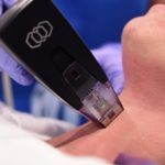 How long does morpheus8 last?