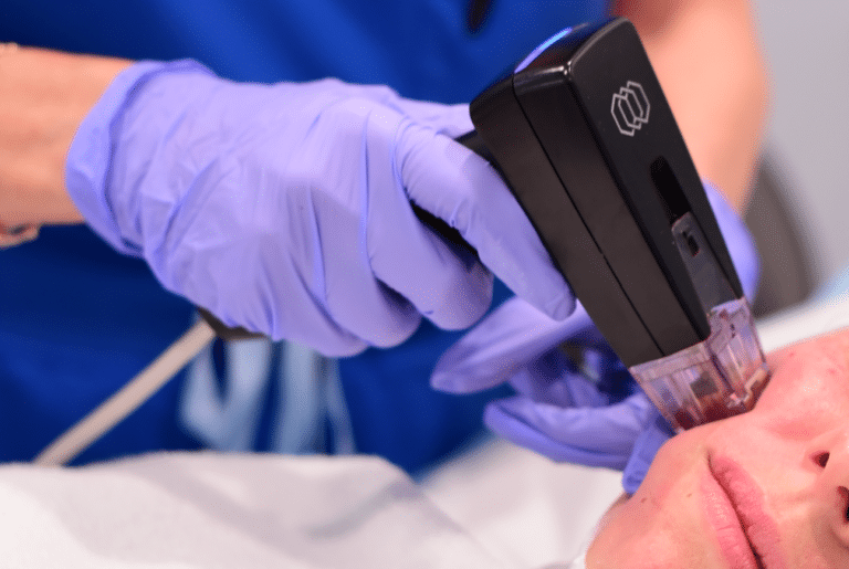 morpheus8 Los Angeles