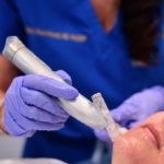 microneedling in beverly hils