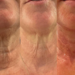 Non Surgical facelift