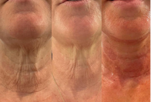 Non Surgical facelift